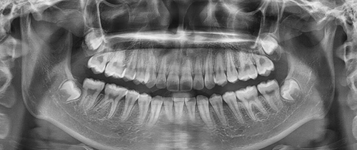 牙片就是牙齿的x线片,是一种不可见的电磁辐射形式.
